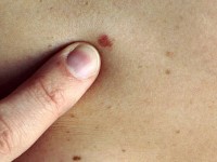Καρκίνος του Δέρματος. Τι να γνωρίζω και πώς να προστατευθώ;