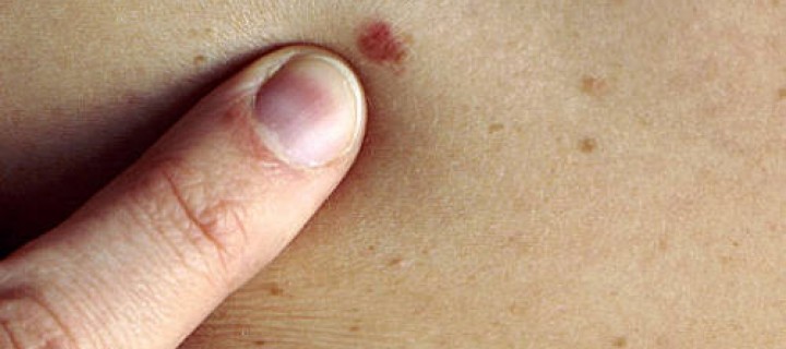 Καρκίνος του Δέρματος. Τι να γνωρίζω και πώς να προστατευθώ;