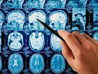 «Ιατρική επανάσταση» φέρνει κλινική δοκιμή κατά όγκου του εγκεφάλου!