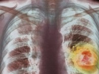 Οι σημαντικές ανακαλύψεις της ανοσο-ογκολογίας και η συνεισφορά της στην αντιμετώπιση του καρκίνου του πνεύμονα