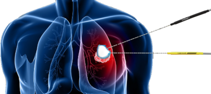 Μεγάλες ελπίδες για τους ασθενείς με καρκίνο του πνεύμονα