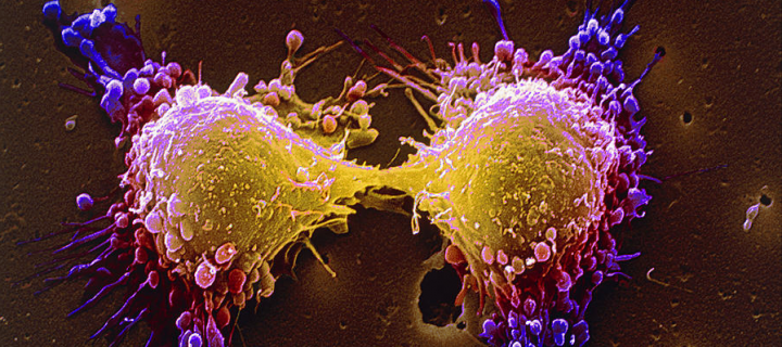 Επιστήμονες χρονολογούν το ιστορικό του καρκίνου