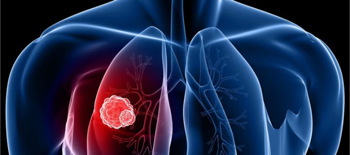 Το pembrolizumab σε συνδυασμό με  χημειοθεραπεία επέκτεινε σημαντικά την επιβίωση και σταμάτησε την εξέλιξη της νόσου σε ασθενείς με καρκίνο του πνεύμονα