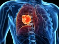 Επιβίωση χωρίς εξέλιξη της νόσου (PFS) σε ασθενείς με καρκίνο του πνεύμονα