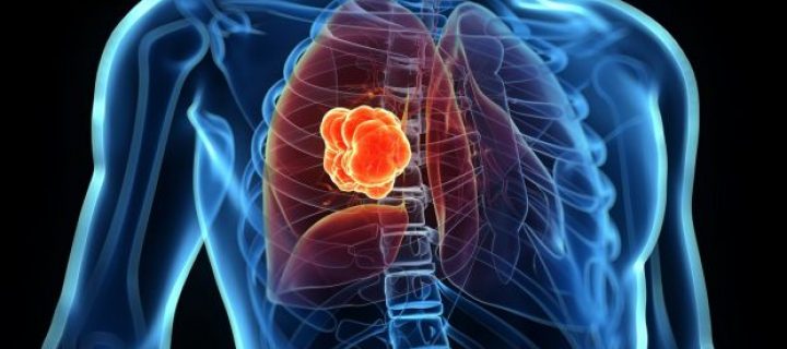 Επιβίωση χωρίς εξέλιξη της νόσου (PFS) σε ασθενείς με καρκίνο του πνεύμονα