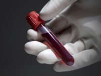 Τεστ αίματος προβλέπει την ανταπόκριση στη θεραπεία για τον Καρκίνο του Μαστού
