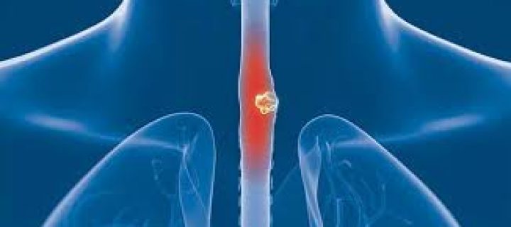 Η χειρουργική επέμβαση της Γαστροοισοφαγικής Παλινδρόμησης μειώνει τον κίνδυνο οισοφαγικού καρκίνου