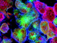 Aντίσταση της Λευχαιμίας στην θεραπεία με CAR-T κύτταρα